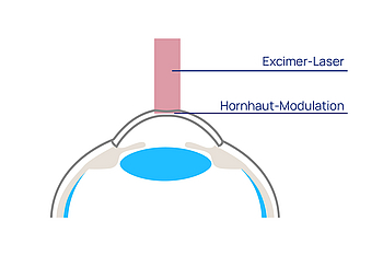 augen op sehen ohne brille photorefraktive keratektomie hornhautmodulation 01