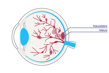 augenkrankheiten netzhauterkrankungen diabetische retinopathie makulopathie 01