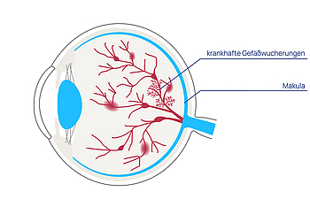 augenkrankheiten netzhauterkrankungen diabetische retinopathie proliferativ 01